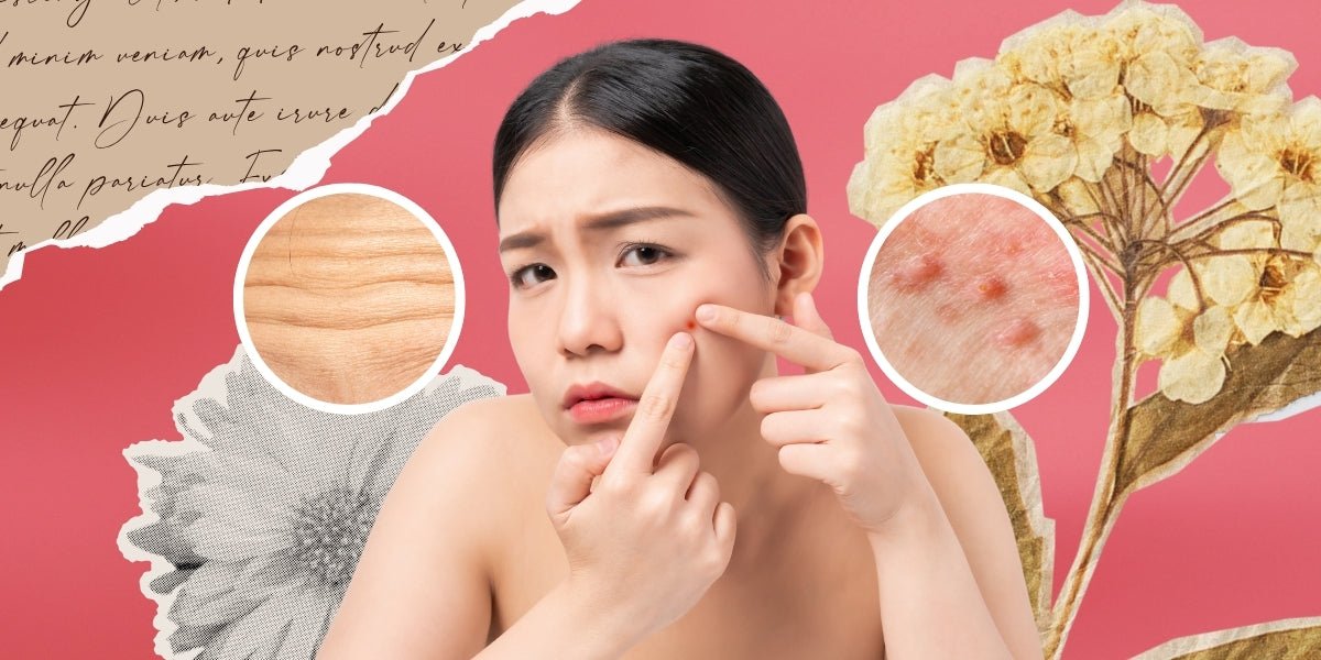 Stressed Out? Here’s How It Shows Up on Your Skin - NANA MALL